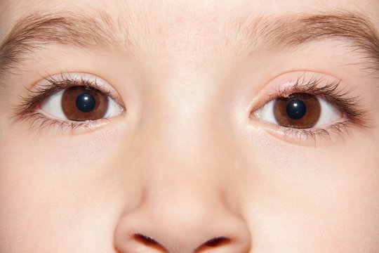 Close-up face of a child with a healthy eye and an infected purulent eye. One eye infection stye - upper eyelid inflammation.