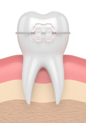 3d render of tooth with ceramic clear brace