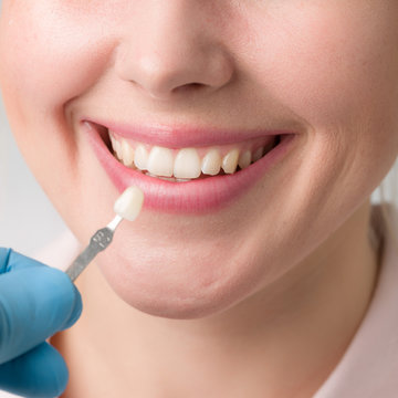 Zahnfarbe für einen Zahnersatz wird an einem Frauenmund mit einer Farbprobe abgeglichen