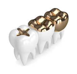 3d render of teeth with different types of dental gold filling