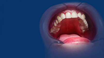 Mouth with bleeding gums on a blue background