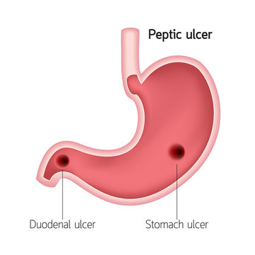 Cross section of human stomach. Peptic ulcer, human heath care. Vector illustration isolated on white background