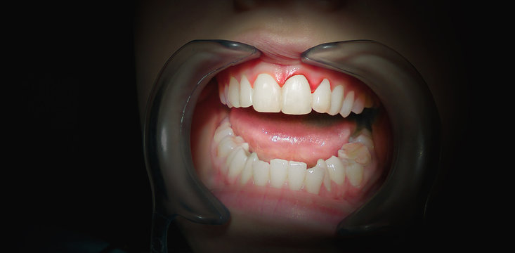 Mouth with bleeding gums on a dark background.