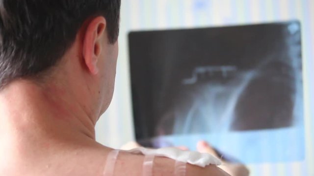 A man with a trauma to the right collarbone of various X-ray images. In the picture it can be seen that he was fixed a clavicle with a metal plate.