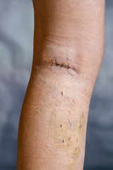 Womans leg after varicose vein surgery