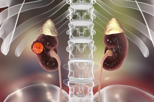 Cancer of kidney, 3D illustration showing presence of cancerous tumor inside kidney tissue