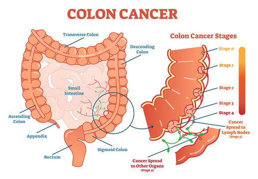 Colon cancer medical vector illustration scheme, anatomical diagram with cancer stages