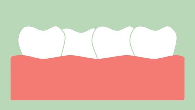 crowding teeth ( malocclusion ) - dental cartoon vector flat render 2d animation in 4K