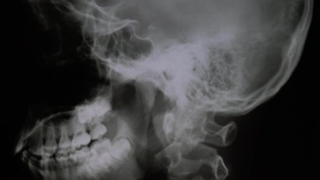 x-ray off skull,side,shot moving by dolly