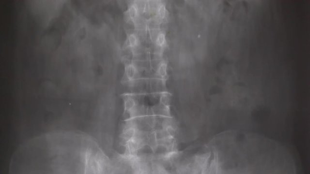 X-ray lumba-sacral spine, pelvis, hip joint,shot moving by dolly
