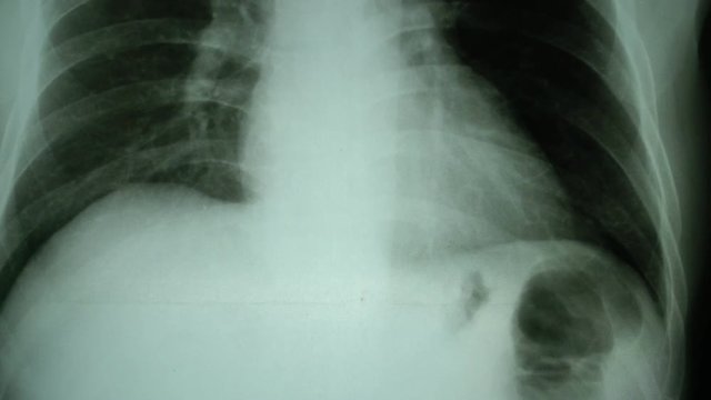x-ray of lungs moving shot by dolly