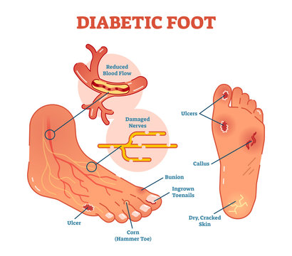 Diabetic foot medical vector illustration scheme with common foot conditions. 