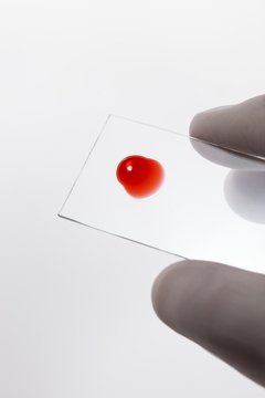 Blood sample on microscope slide