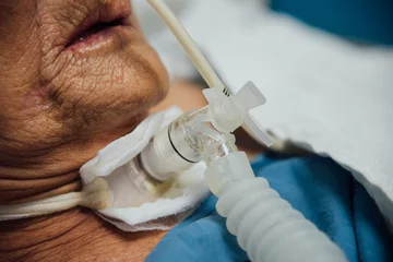 Foto op Plexiglas Patient do tracheostomy and ventilator in hospital © pongmoji