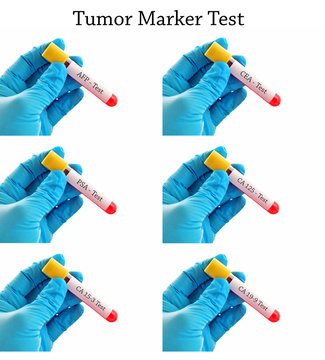 Mixed of blood sample tubes for tumor marker test, AFP, CEA, PSA, CA125, CA15-3, CA19-9