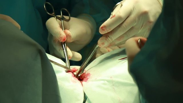 real surgery team operating throat adenoma close up