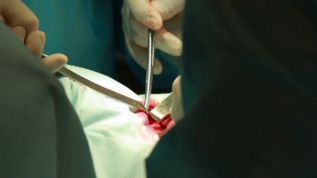 real surgery team operating throat adenoma close up