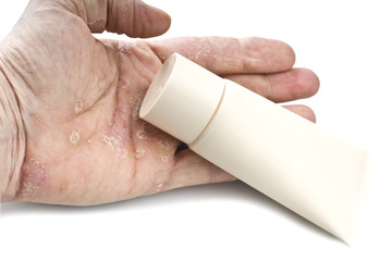 Psoriasis, skin disease on the joints of the body