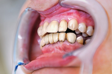 Mouth with  prosthetic  teeth