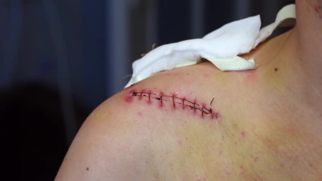 The nurse removes the gauze bandage imposed on the right shoulder to the man. He treats the surgical suture with an antiseptic and applies a bandage back. The dressing is fixed with adhesive plaster.