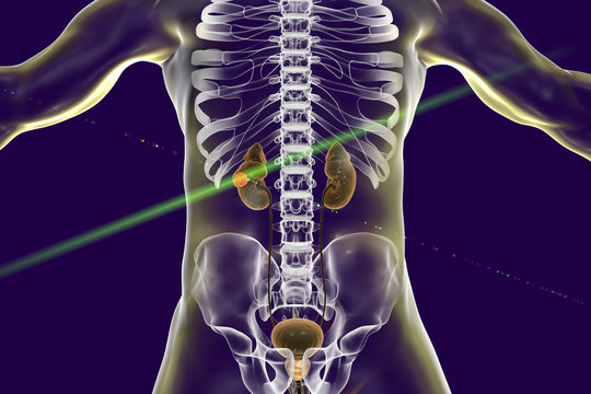 Treatment of kidney cancer with laser, conceptual image. 3D illustration. Concept of laserotherapy of tumors