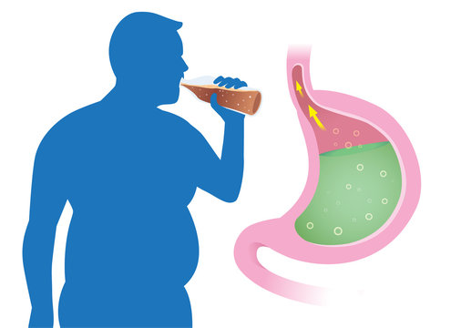 Fat People Have Acid Reflex In Stomach From Drink Carbonated Beverages. Illustration About Gastroesophageal Reflux Disease.