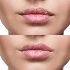 Lips with herpes before and after treatment.