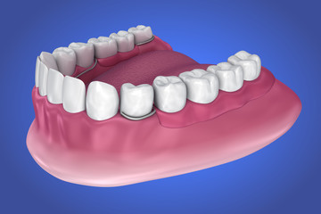 Removable partial denture. Medically accurate 3D illustration