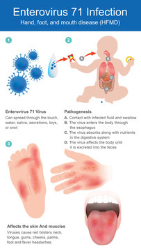 Enterovirus 71 Infection..Hand, foot, and mouth disease.