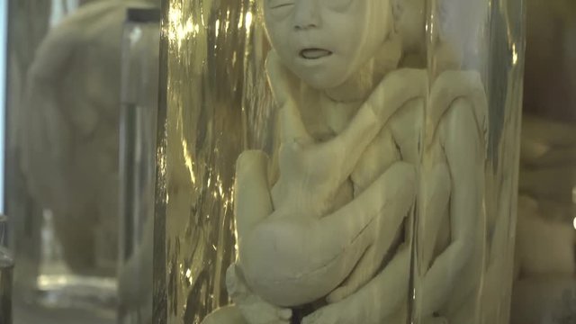 Anatomical preserved human specimens, ugliness, anomalies. Human parts of the body preserved in formalin for scientific study by scientists. Exhibition items in autopsy room.