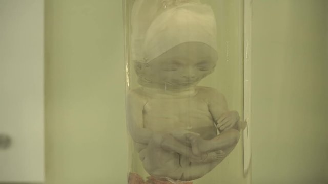 Anatomical preserved human specimens, ugliness, anomalies. Human parts of the body preserved in formalin for scientific study by scientists. Exhibition items in autopsy room.