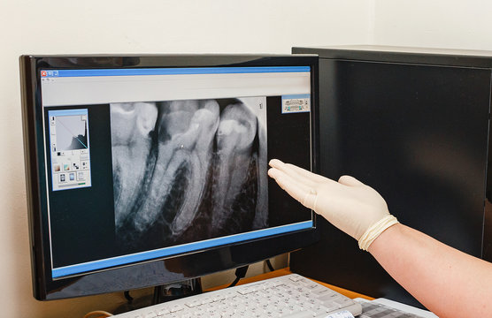 Close-up Of A Dentist's Hand pointing On computer screen With Dental X-ray image of carious and damaged teethv