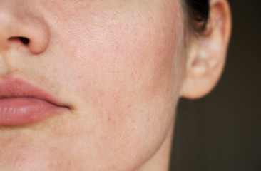 skin pigmentation. expanded pores