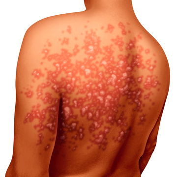 Psoriasis Illness