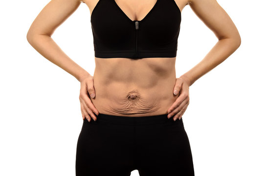 Diastasis recti. Woman's abdomen divergence of the muscles of the abdomen after pregnancy and childbirth. Loose skin on belly.