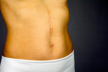 Fototapeta na wymiar scars removal concept, large scar after surgery on the abdomen young woman, blurred neutral background, selective focus