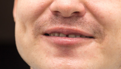 Bristles on the mustache of a man