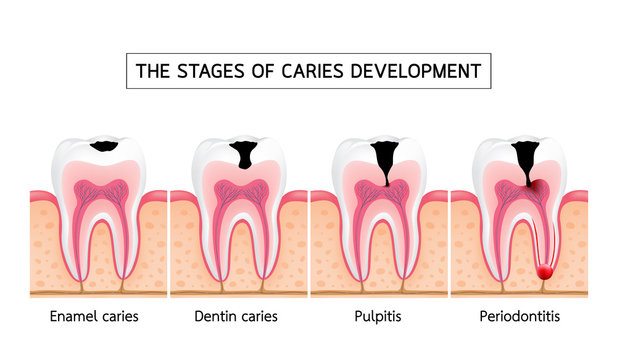 Stages of caries development. Enamel caries, Dentin caries, Pulpitis and Periodontitis. Dental care info-graphic, illustration on white background.