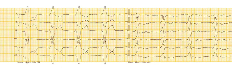 ECG with rhythm of artificial pacemaker (ventricular stimulation)