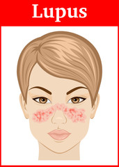 Illustration of Lupus