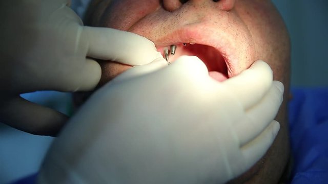 The mouth implants the tooth . Dental implant procedure . How do dental implants work graphic representation from dental implant placement to completing the tooth.