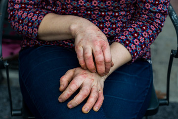 Young woman with dry and stressed red dyshidrotic eczema covered hands