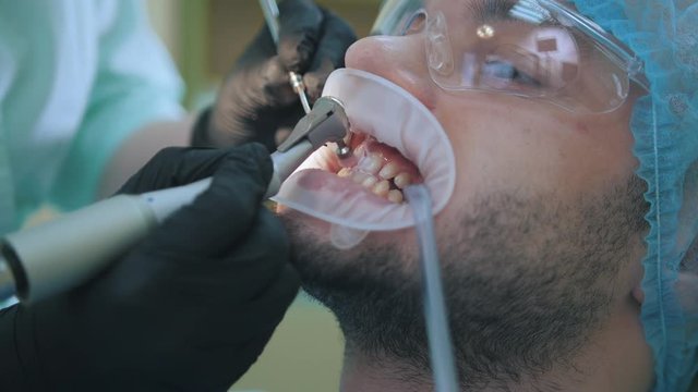 Doctor and patient with lip dilator in the dental office, close up of polishing with stomatological brush