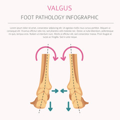 Foot deformation as medical desease infographic. Valgus and varus defect