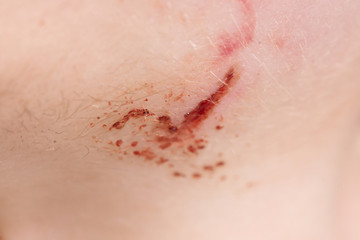 Fototapeta premium Wound on human skin
