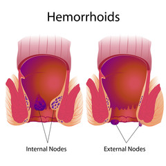 Hemorrhoids external and internal nodes