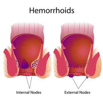 Hemorrhoids External And Internal Nodes