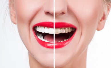 White teeth and red lips.  Perfect female smile after whitening teeth.