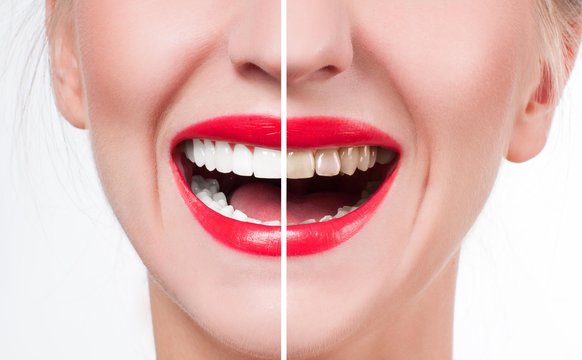 Đánh răng đúng cách đem tới lợi ích như thế nào