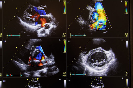 Heart ultrasound image on a computer screen.